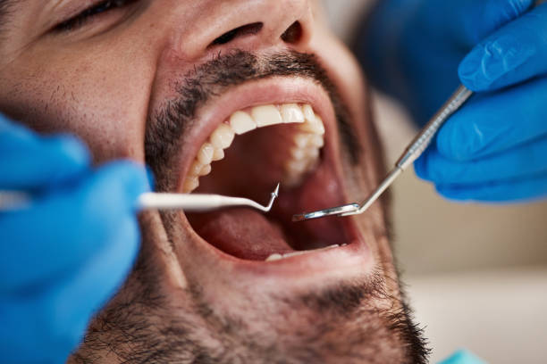 Best Emergency Wisdom Teeth Removal in Monticello, AR