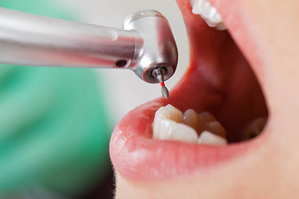 Best Emergency Root Canal Treatment in Monticello, AR